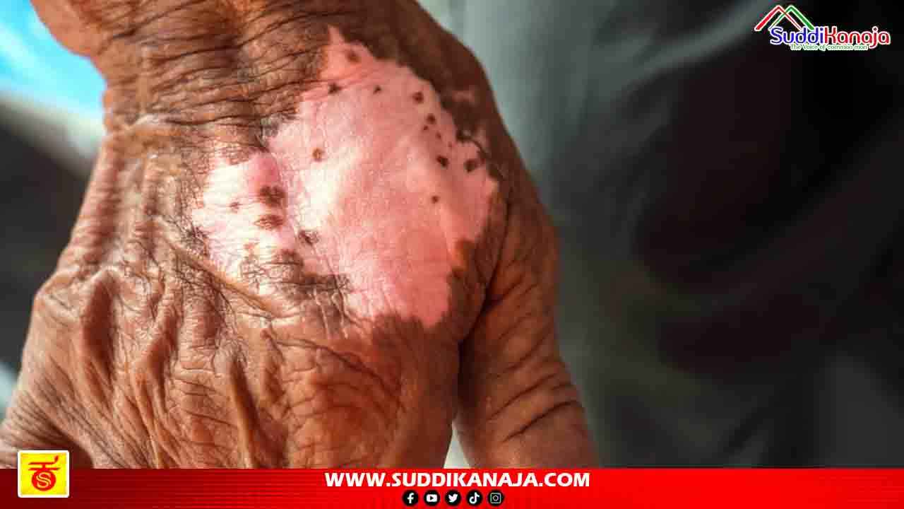 Leprosy